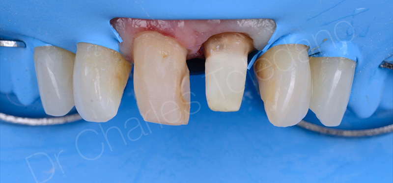 la 21 est restaurée par un composite associé à un tenon fibré