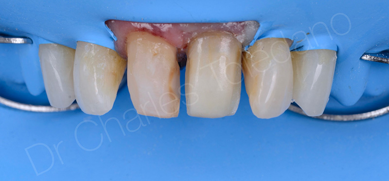 Coiffe céramique est collée sur le faux-moignon