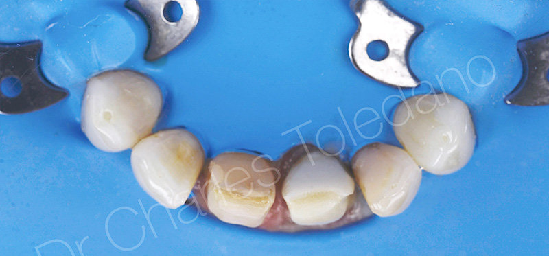 Coiffe céramique est collée sur le faux-moignon