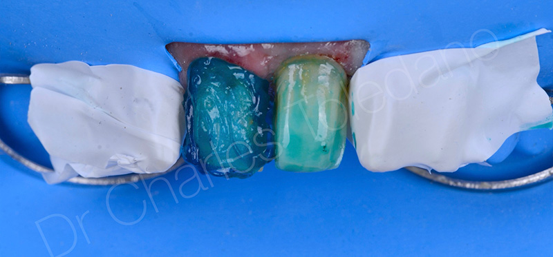 l’émail de la 11 est mordancé