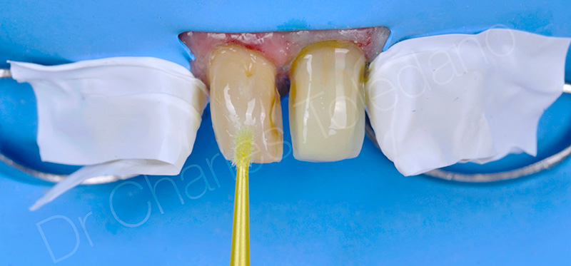 un adhésif universel est appliqué par frottement sur l’ensemble des surfaces