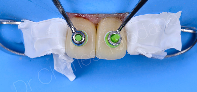Deux facettes en disilicate de lithium