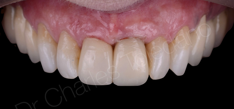 Vue immédiate des facettes après dépose du champ opératoire