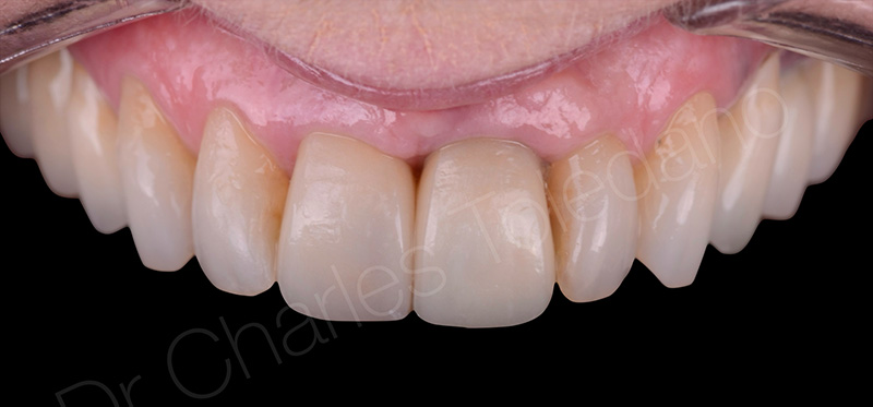 vues des facettes à 15 jours postopératoires montrant la luminosité équivalente obtenue sur les deux incisives centrales