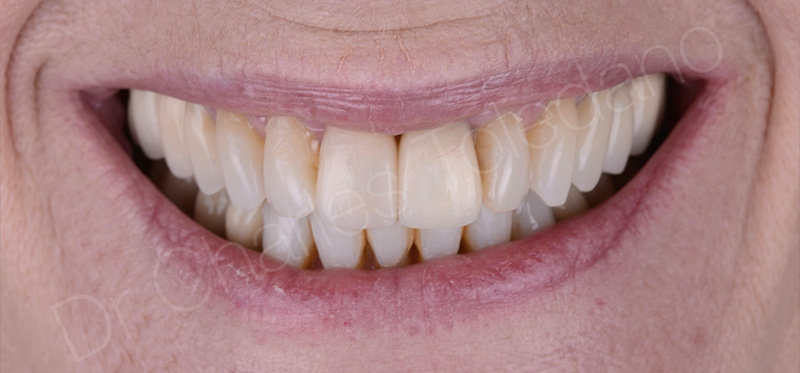 La facette sur coiffe, vues à 15 jours postopératoires montrant la luminosité équivalente obtenue sur les deux incisives centrales