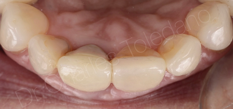 Vue incisale illustrant la symétrie de forme et d’épaisseur des deux facettes vestibulaires collées