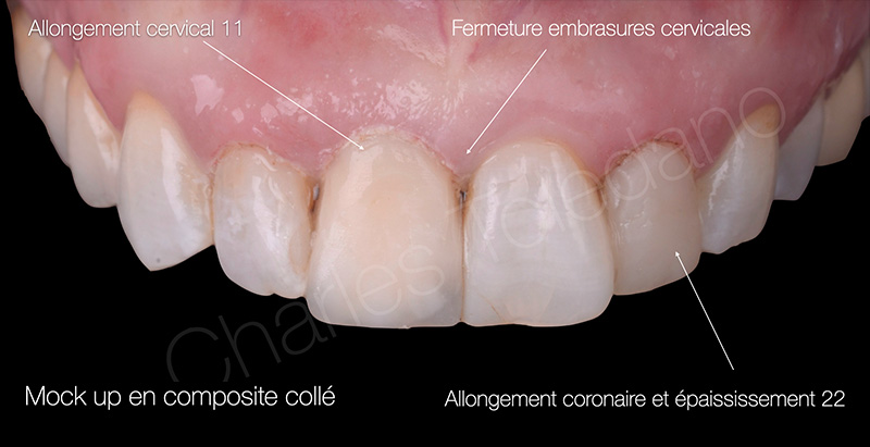 La facette sur coiffe, composites directs