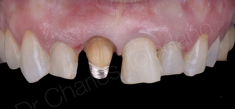 dépose de la couronne sur 11