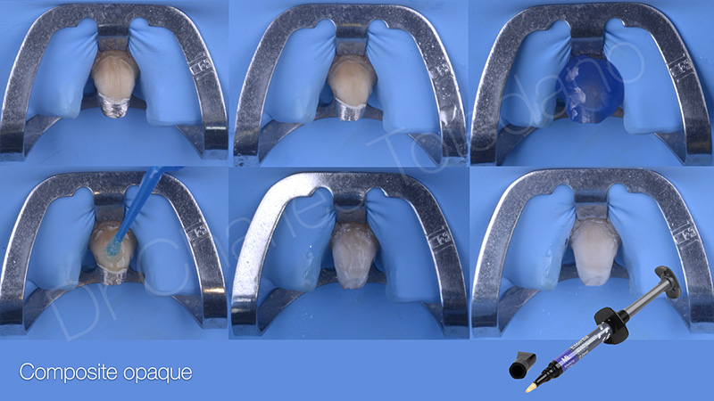 Moignon recouvert d’un adhésif universel et d’un composite de masquage opaque