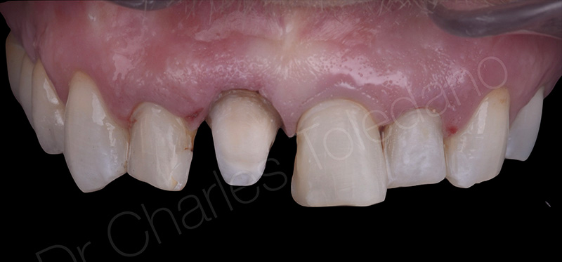 La facette sur coiffe, corriger la différence de volume à reconstituer