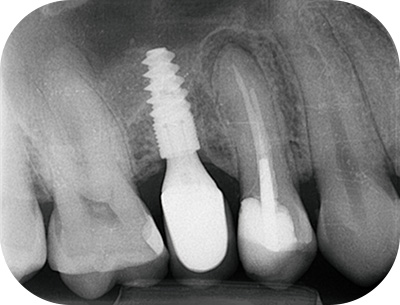 prémolaire, le composite présente une étanchéité insuffisante
