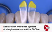 Restaurations antérieures injectées et triangles noirs avec matrice BioClear