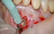 incision VISTA en chirurgie endodontique