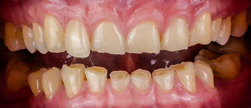 Usure dentaire Bruxisme